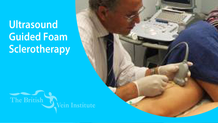 Ultrasound guided foam sclerotherapy - British Vein Institute